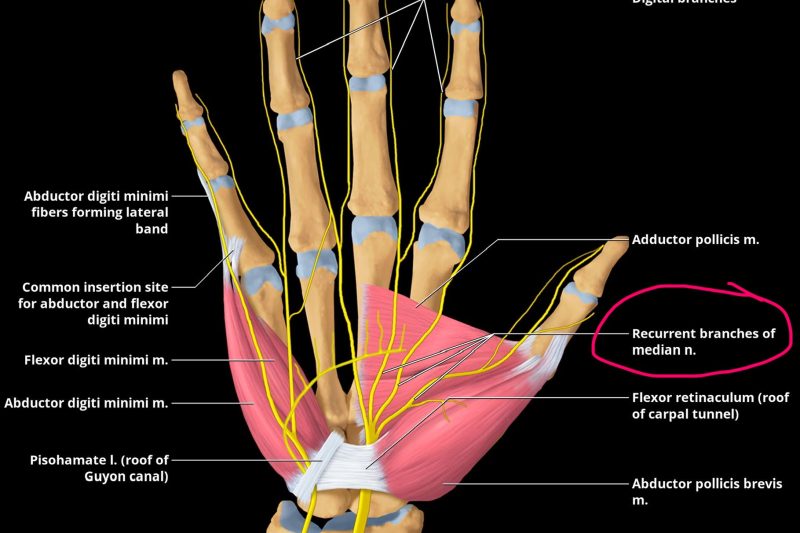 Carpal Tunnel Syndrome